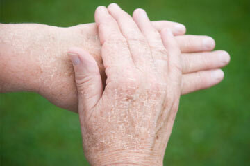 What Can I Do For Extremely Dry Hands Howstuffworks