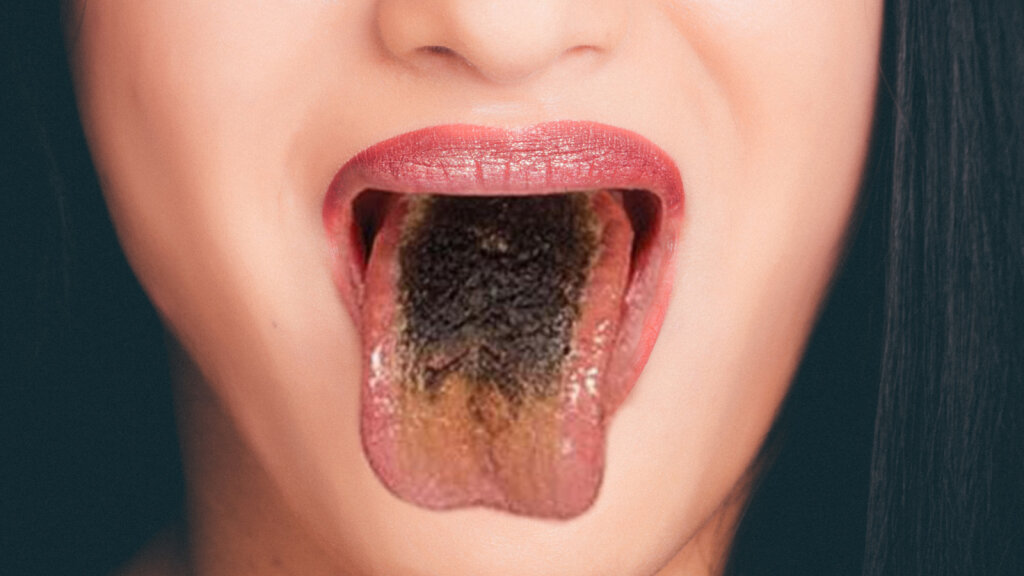 Black Hairy Tongue Its Gross But Youll Live How