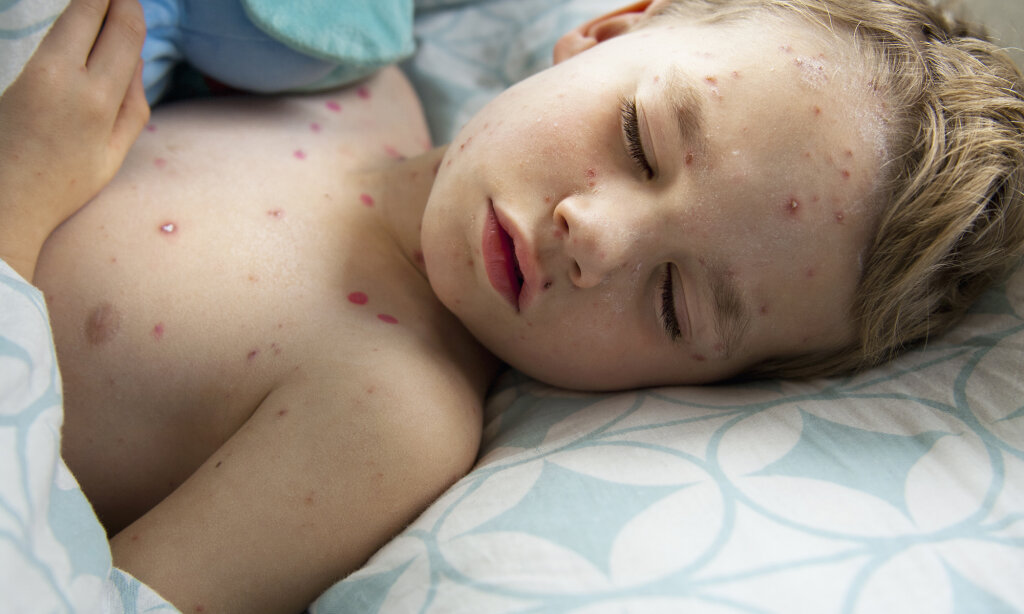 chicken-pox-treatments-scratching-the-itch-chicken-pox-treatments