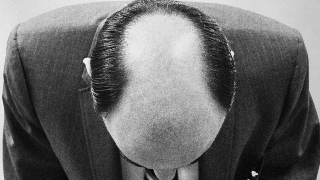 Why Aren’t There More Patterns In Male Pattern Baldness