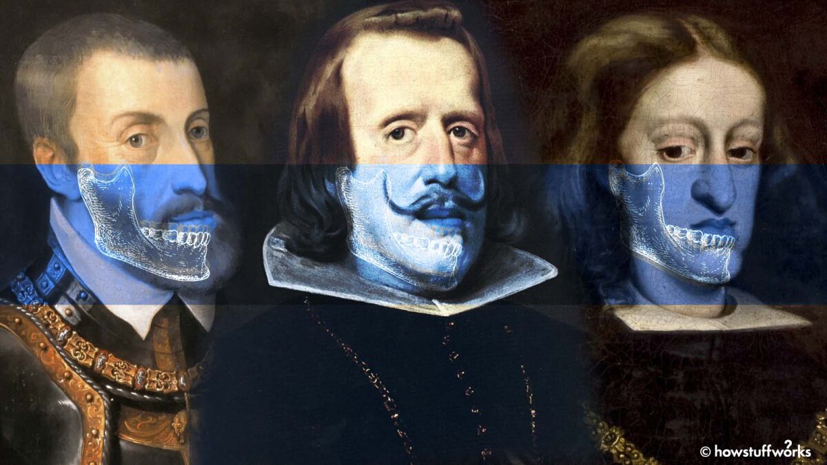 How Centuries of Inbreeding Led to the Distinctive 'Habsburg Jaw