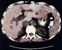 cat-scan-liver.jpg
