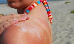 10 Home Remedies For Sunburn Howstuffworks