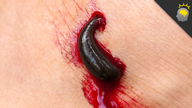Here&#39;s What Happens When You Swallow a Leech | HowStuffWorks