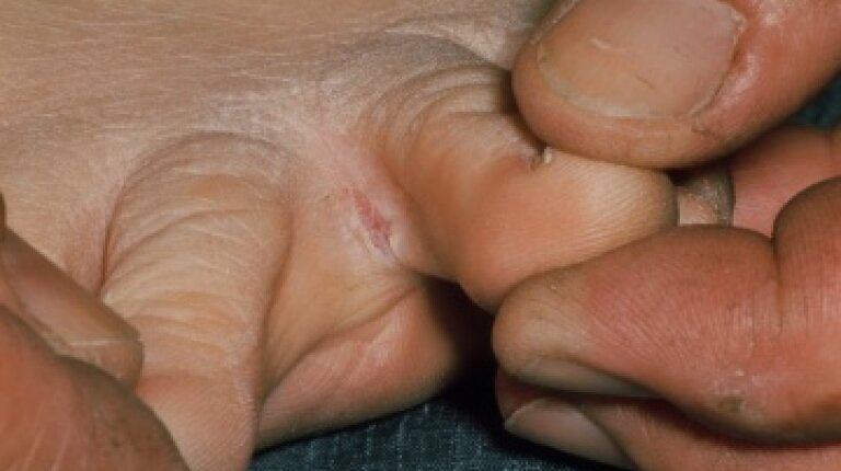 skin peeling on feet after shower