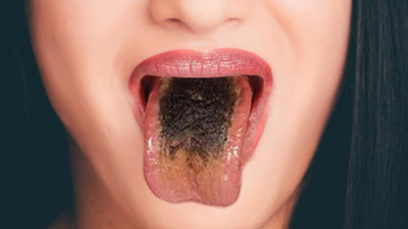 Black Hairy Tongue: It's Gross, but You'll Live | HowStuffWorks