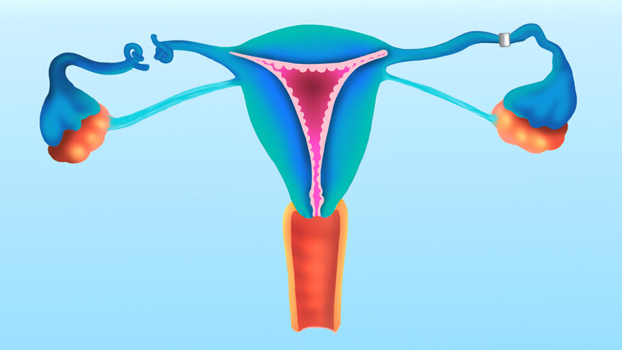 Century-old Procedure Treats Infertility by Flushing Fallopian Tubes ...